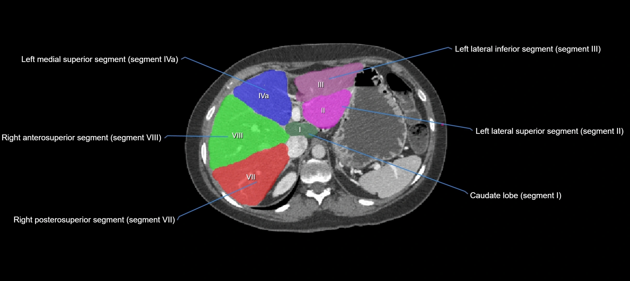 CT liver segments axial cross sectional anatomy labelled image-00051.webp